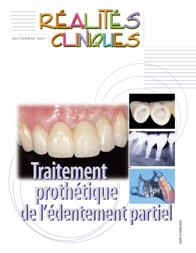 Traitement prothétique de l'édentement partiel