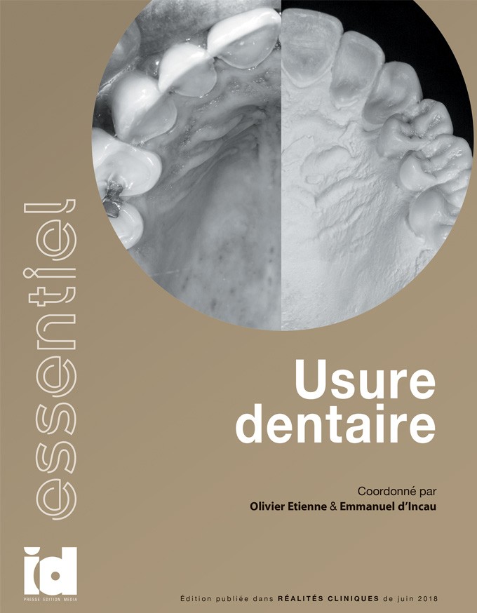 L'essentiel – Usure dentaire