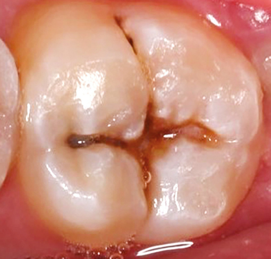 1. Face occlusale de 47 cariée mais peu délabrée permettant une reproduction à l’identique selon la technique de la stamp technique.
