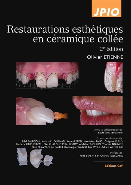 Restaurations esthétiques en céramique collée - 2e édition